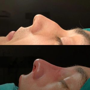 Burun Estetiği Öncesi Sonrası