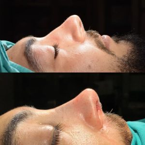 Burun Estetiği Öncesi Sonrası